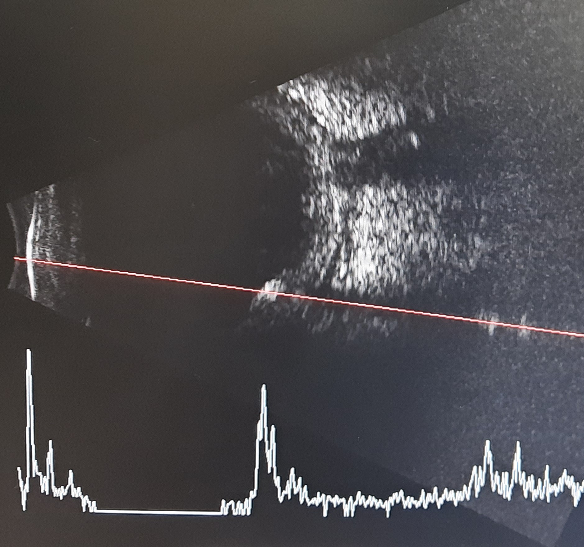 Ultrasound B scan of same foreign body at low gain. The hyperechoicity is persisting at low gain with high spike on A scan.