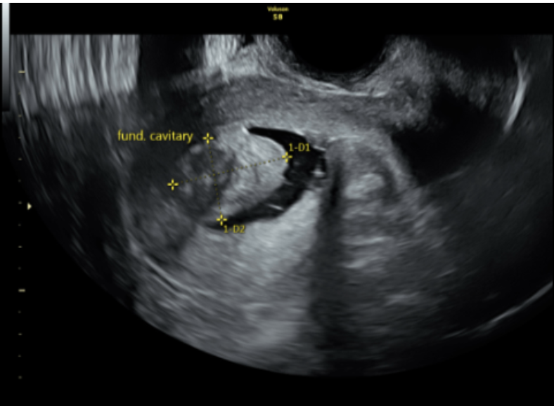 Saline infusion sonohysterogram of intracavitary fibroid. Preparation for in vitro fertilization includes evaluation for etiologies of infertility as well as potential barriers to success for in vitro fertilization. This figure is an example of saline infusion sonohysterogram, in which a saline infusion is introduced into the uterine cavity during transvaginal ultrasound to identify intracavitary abnormalities. Here a fundal cavitary fibroid is noted, which if left untreated, may reduce implantation success rates and increase miscarriage rates in achieved pregnancies.