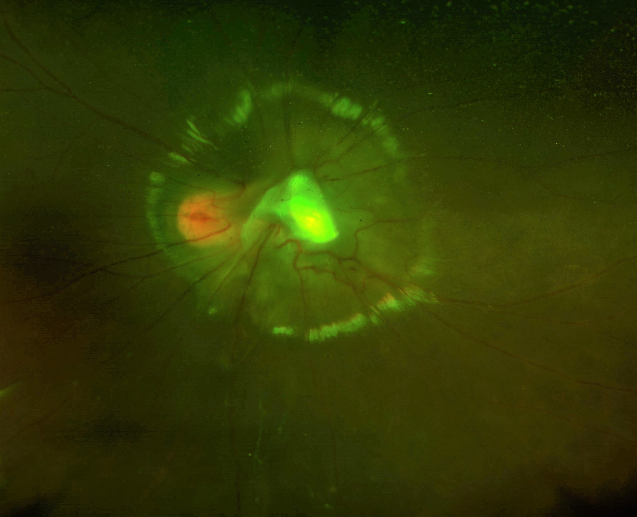 A posterior pole toxocara granuloma with a fibrous band extending to the optic disc.