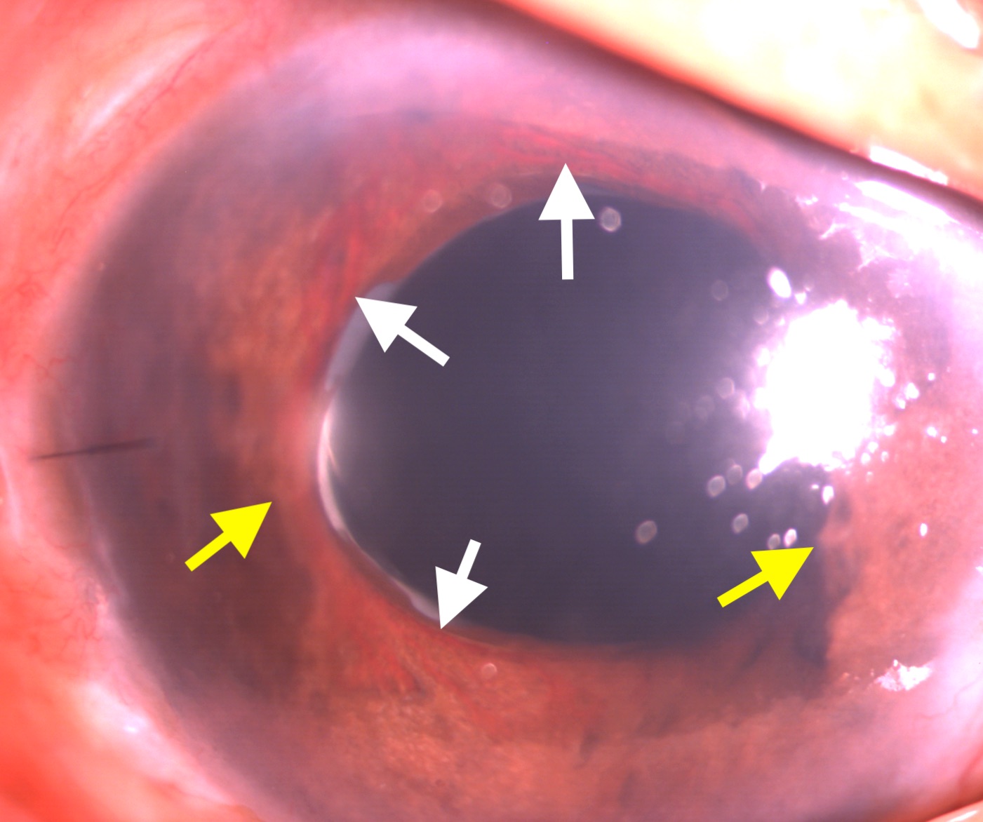 Figure 2- Neovascularization of iris (white arrow marks) and peripheral anterior synechia (yellow arrow marks) in a patient w