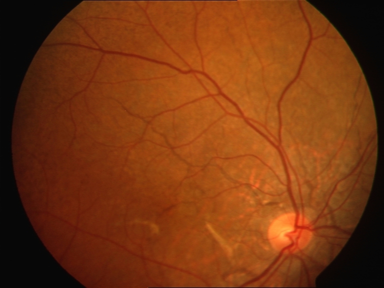 <p>Fundus With Angioid Streaks. The image depicts the fundus of the right eye with angioid streaks.</p>