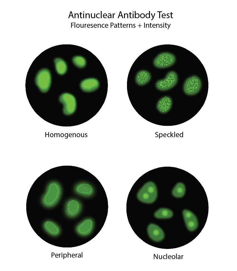 Diagram of antinuclear antibody fluorescence patterns.