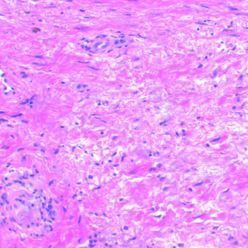 Nephrogenic systemic sclerosis histopathology slide showing dermal fibrosis and an increase in cellularity.
