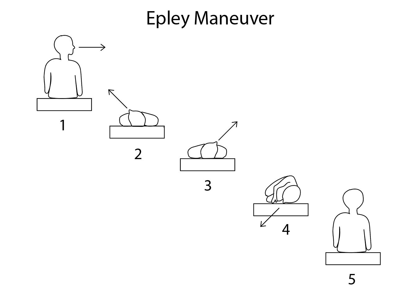 Diagram showing the steps of the Epley maneuver.