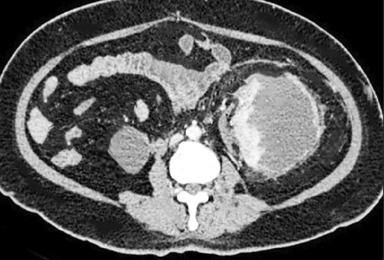 CT scan showing page kidney.