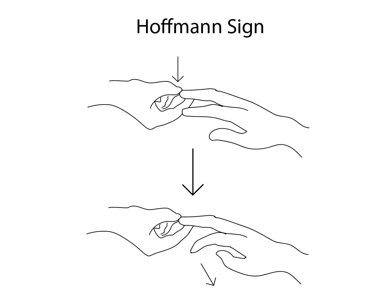 Diagram depicting a positive Hoffmann sign.
