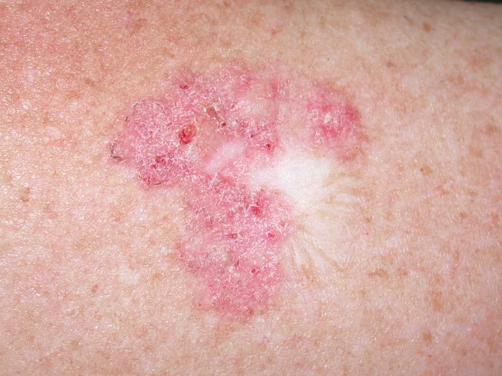 <p>Superficial Basal Cell Carcinoma