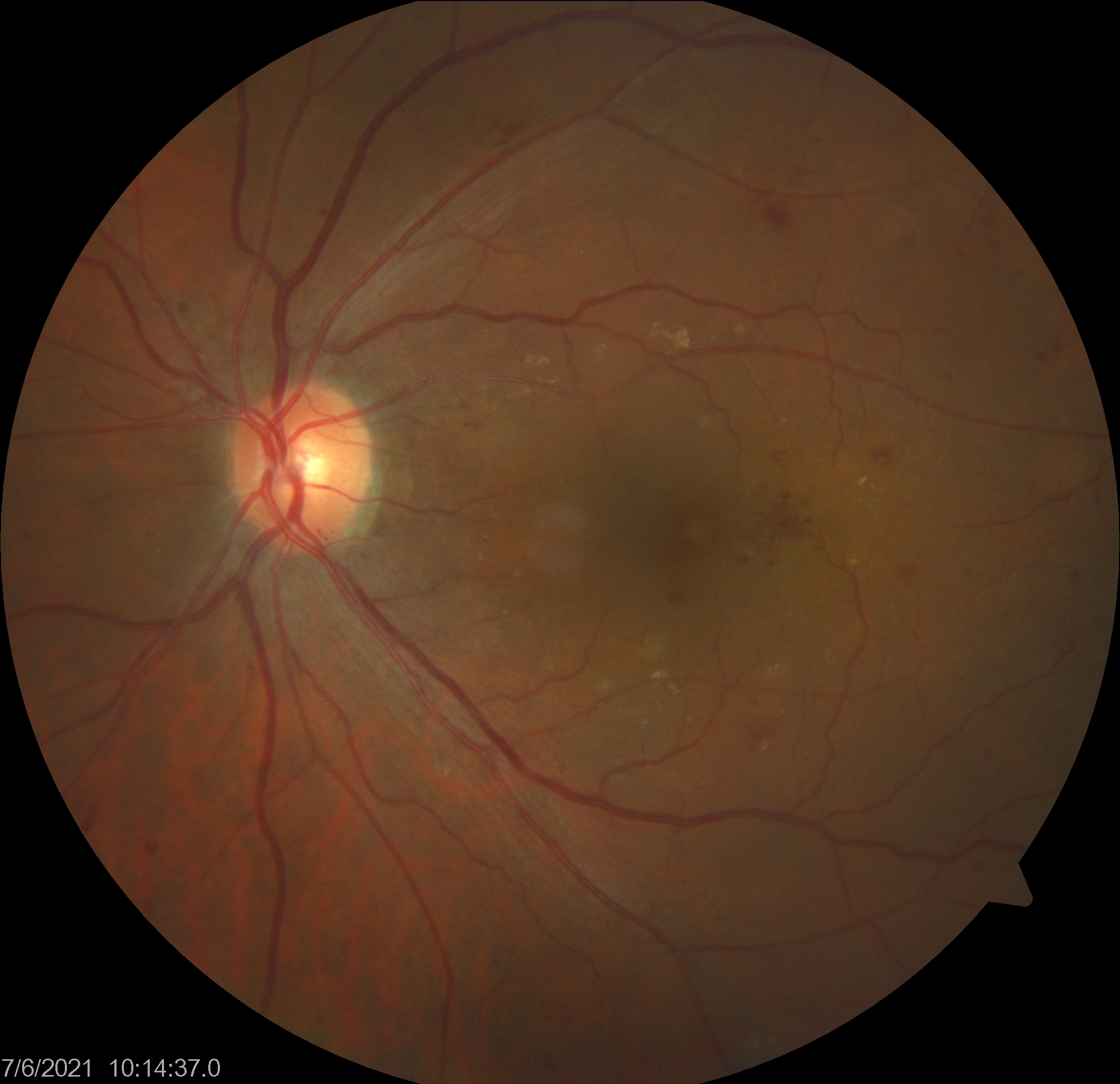 Left eye fundus photo showing diabetic macular edema (DME) and non proliferative diabetic retinopathy (non PDR).
Hard exudates can be visualized in the macula and hemorrhages in the four quadrants of the retina.