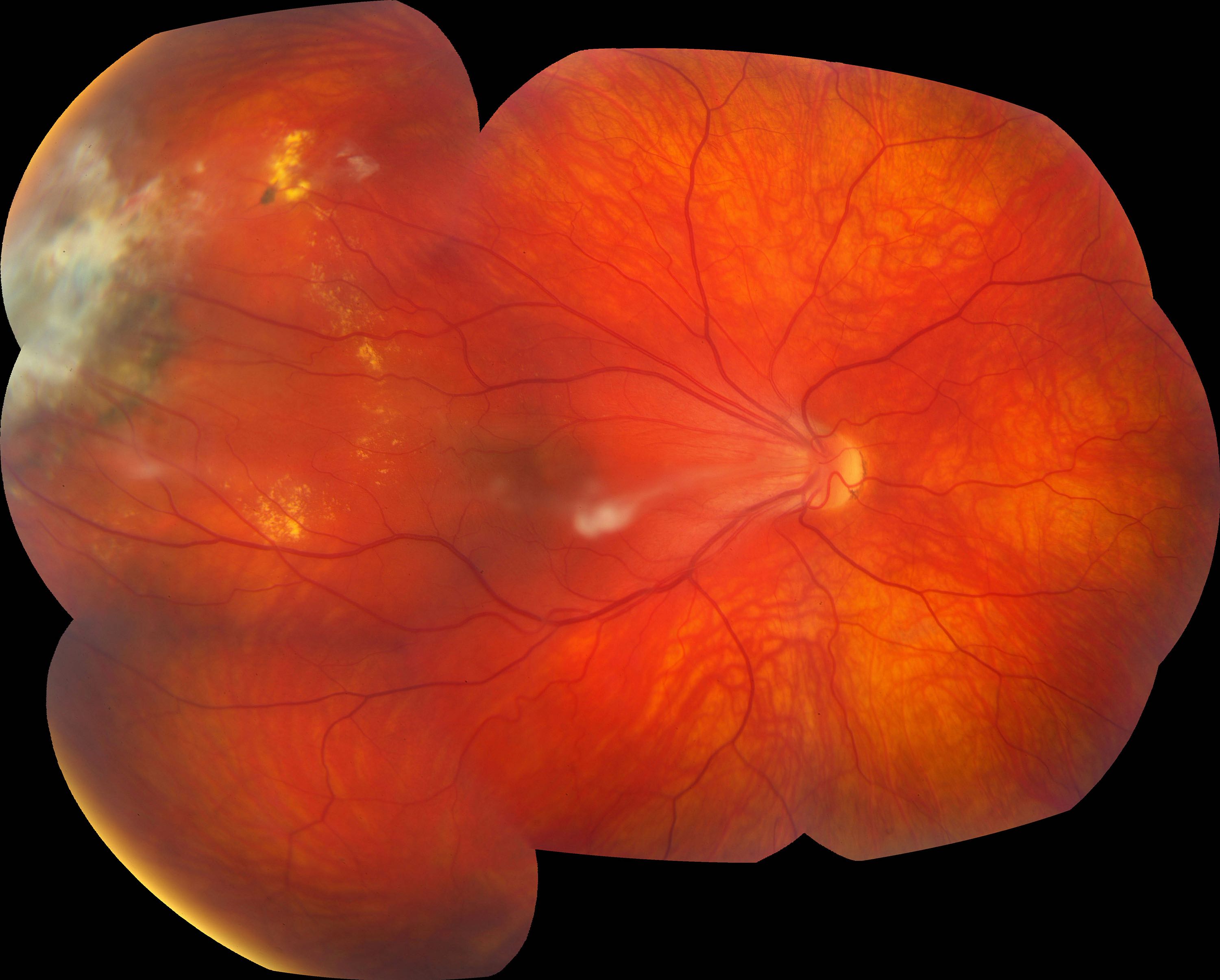 Macular edema in a case of familial exudative vitreoretinopathy: right fungus shows a tilted, small optic nerve with a vitreal adhesion from the disc to a temporal scar along with macular edema, temporal macular traction, epiretinal membrane, vascular dragging and tortuosity, as well as a fibrotic white lesion at 10 o’clock, surrounded by retinal pigment epithelial changes, and nearby exudates.