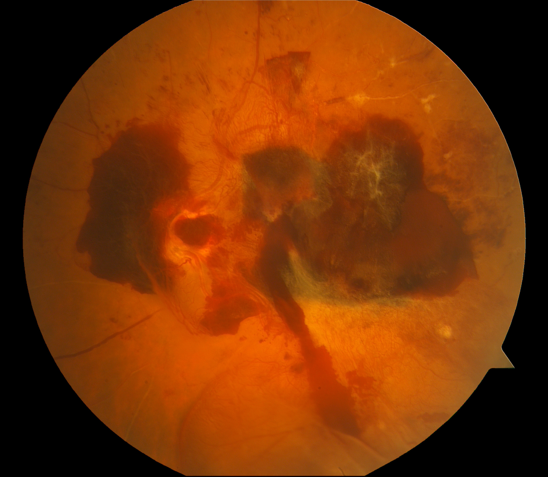 Diabetic retinopathy: Proliferative Vitreoretinopathy (PVR) with overlying hemorrhage. PVR is caused by previous retinal detachments leading to scars that prevent the retina from reattaching appropriately.