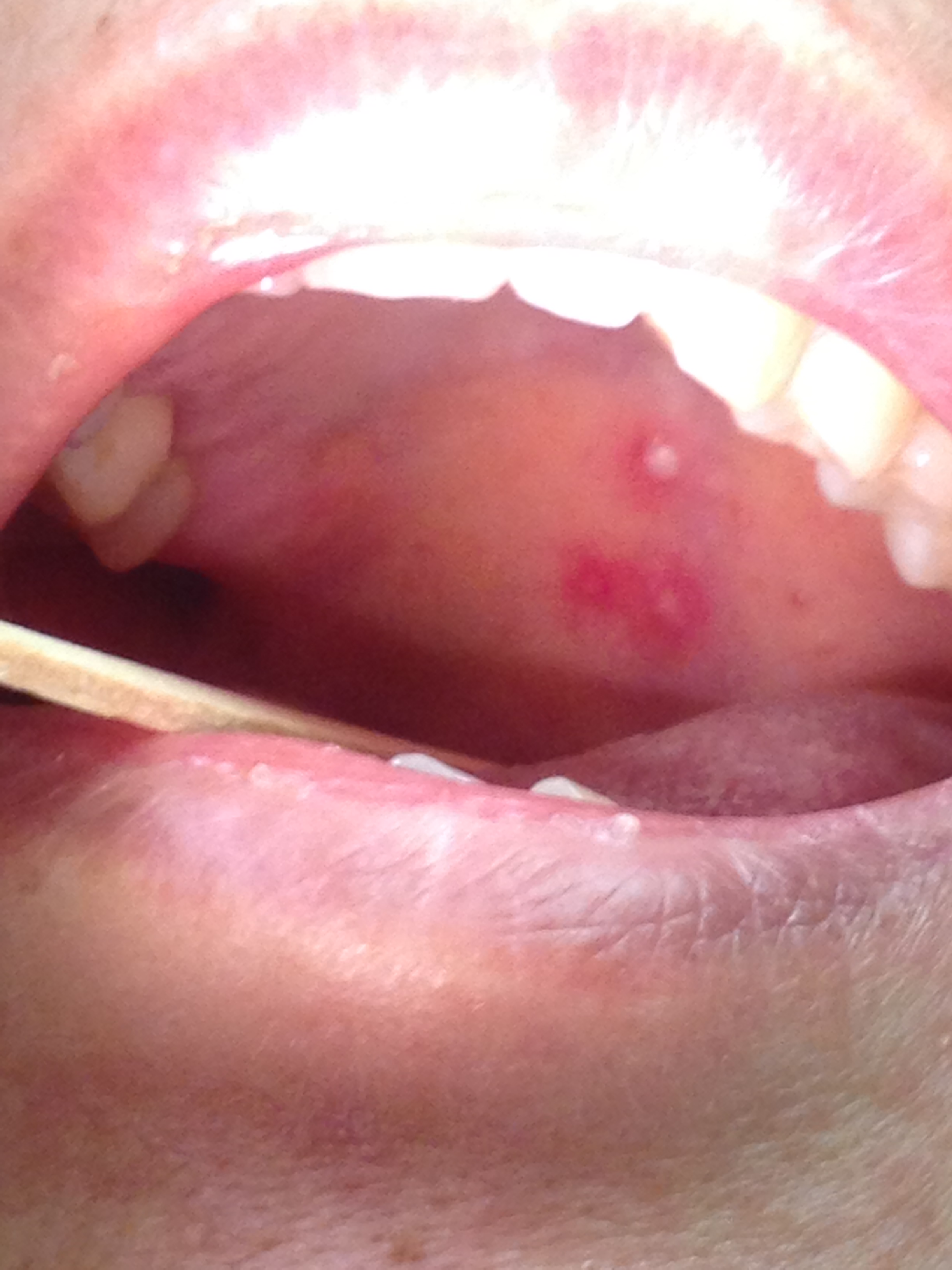 Vesicles on the left soft palate in Ramsay Hunt syndrome