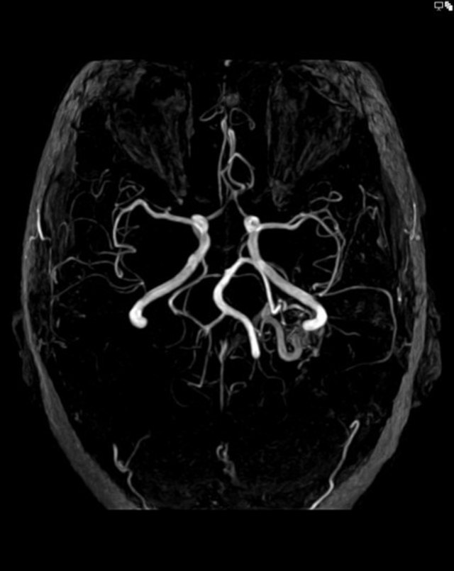 Angiography showing arteriovenous malformation of the brain.