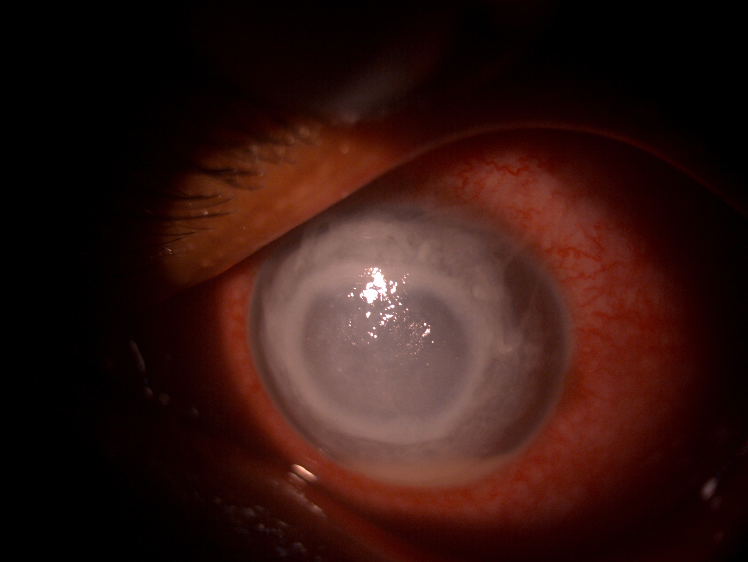 Slit lamp image of the patient depicting Klebsiella endogenous endophthalmitis in a patient with chronic urinary tract infection