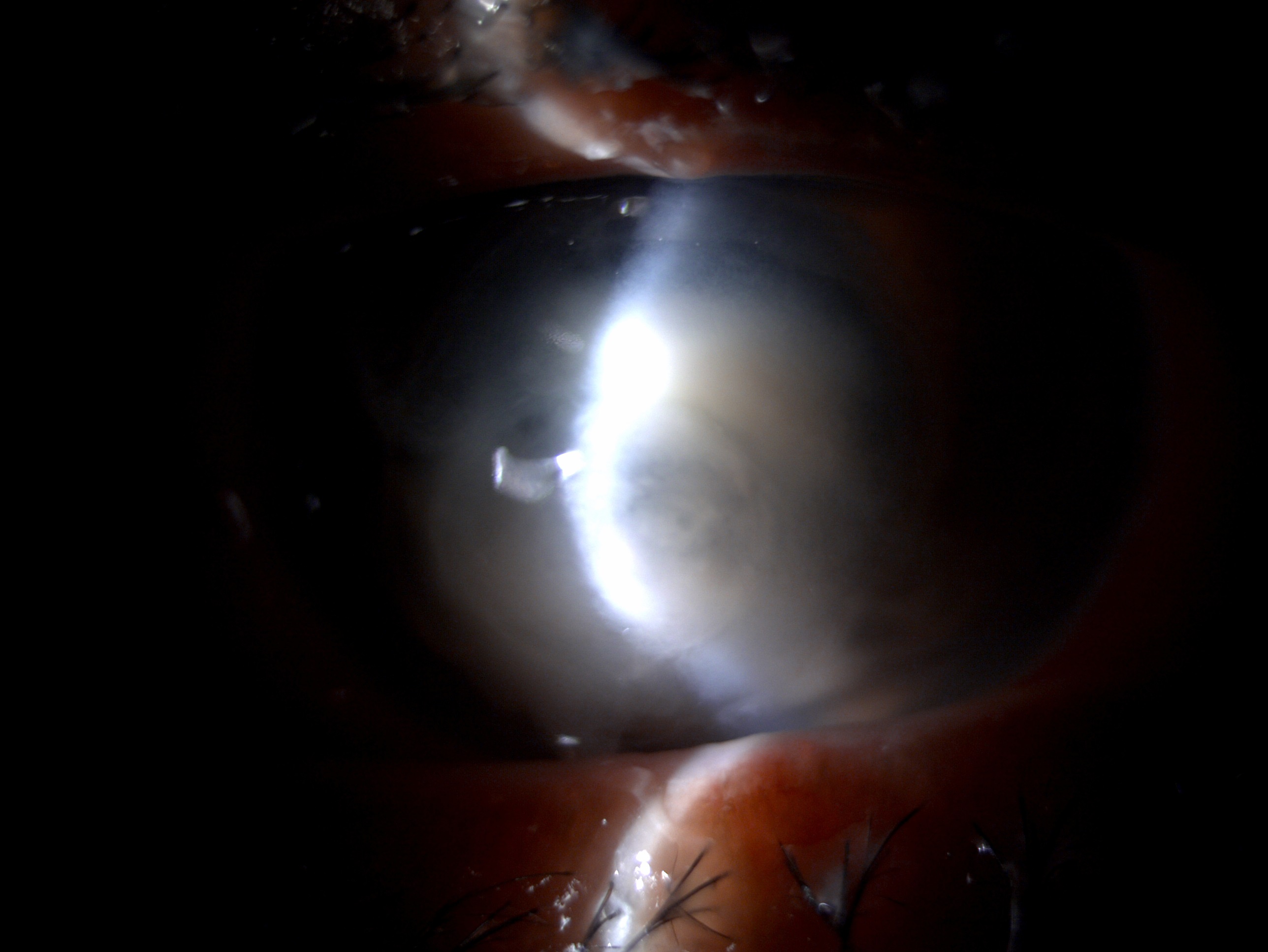 Slit lamp image of the patient depicting corneal melt, full thickness corneal infiltrate in a patient with pseudomonas endogenous endophthalmitis 