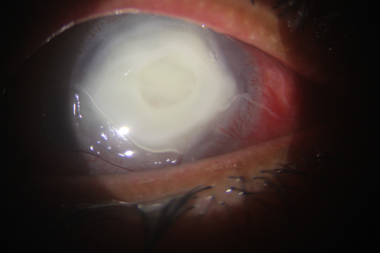 Slit lamp image of the patient depicting 8x8 mm full thickness corneal infiltrate with corneal melt, corneal abscess in a patient with staphylococcal endogenous endophthalmitis