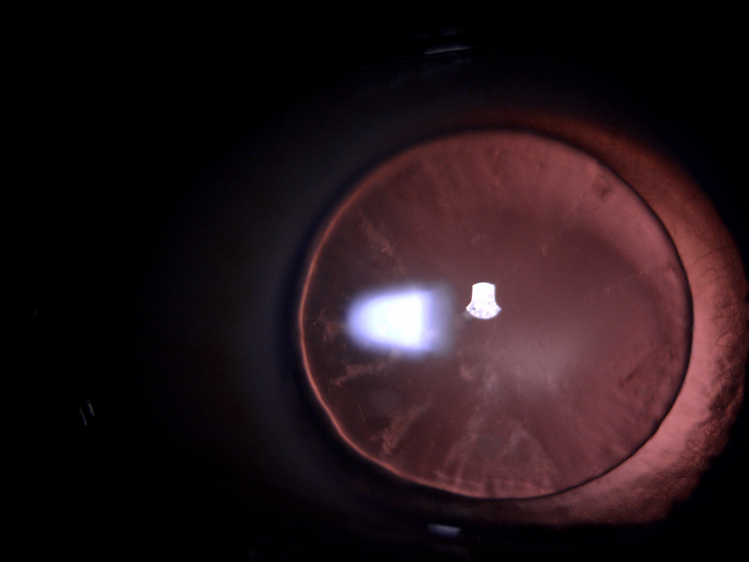 Retro-illumination slit lamp image of the patient depicting small diameter microspherophakic lens with an equator of lens visible on full mydriasis in a patient with Marfan's syndrome