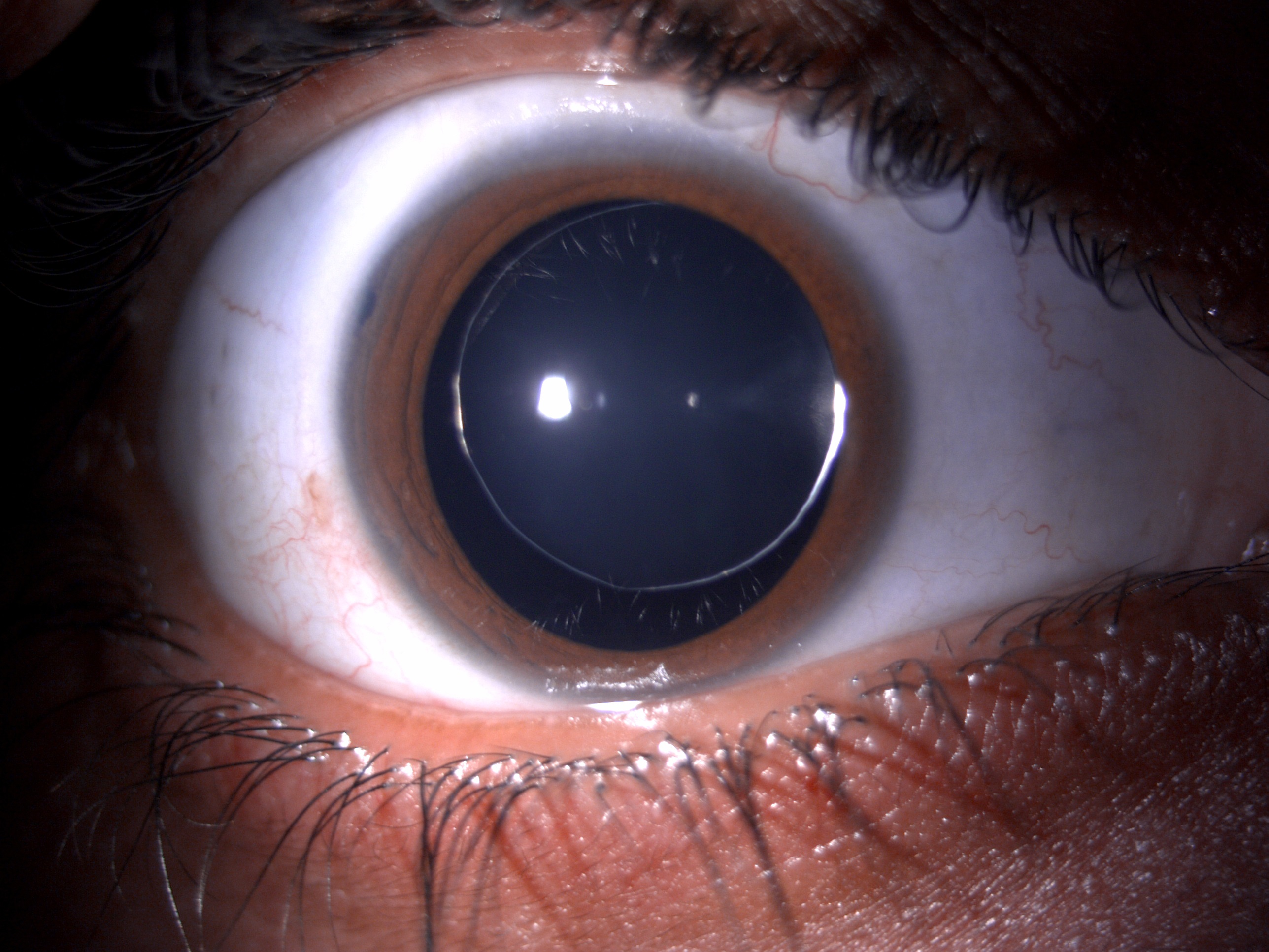 Digital slit lamp image of the patient depicting small microspherophakic clear lens with equator of lens visible under full mydriasis in a patient with Weill-Marchesani syndrome