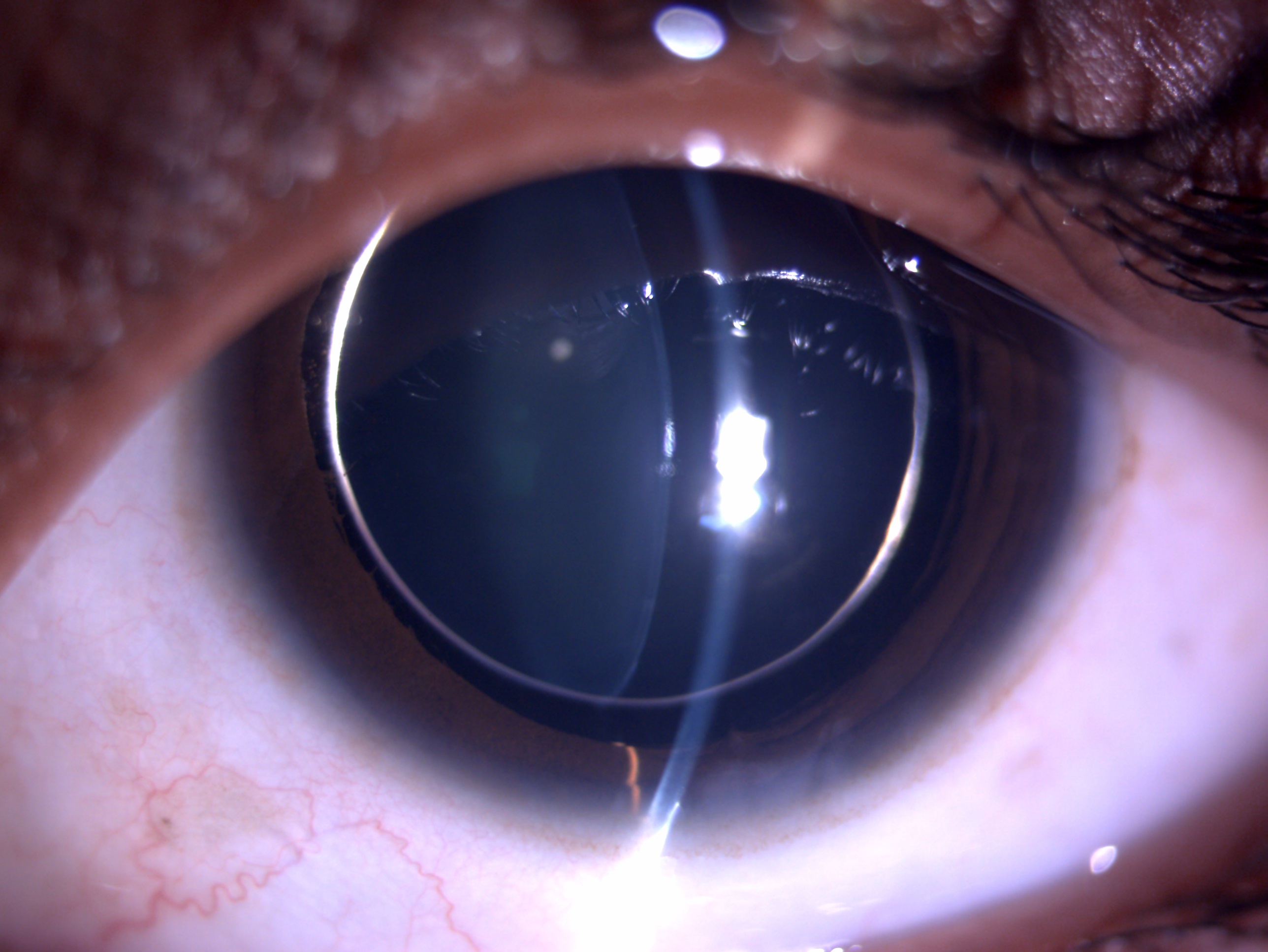 Slit lamp image of the patient depicting small globular, spherical clear lens with 360 deficient zonules and equator of lens visible on full mydriasis in a patient with homocystinuria