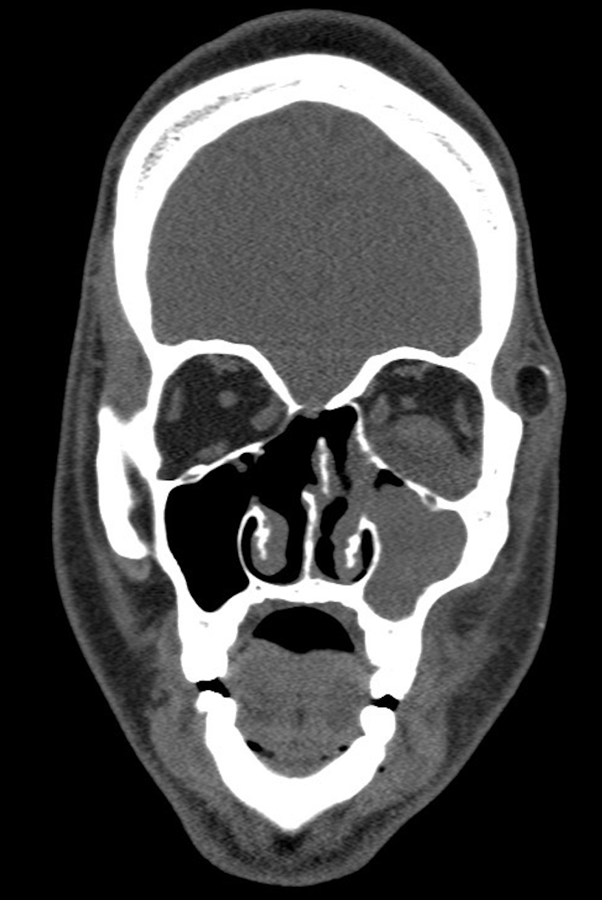 <p>Fungal Sinusitis. CT scan displaying right-sided sinus infection.</p>