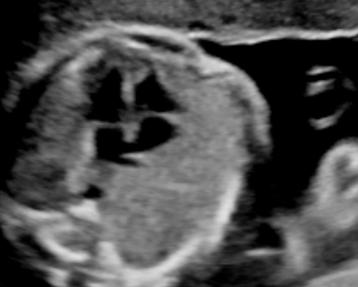 Four chamber heart view of a second trimester fetus