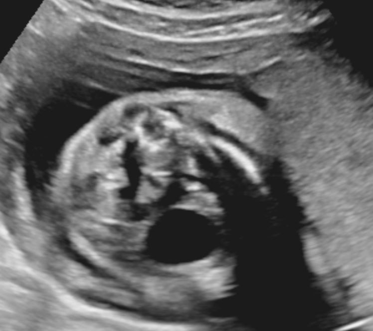 Evaluation of the bladder in a second trimester fetus