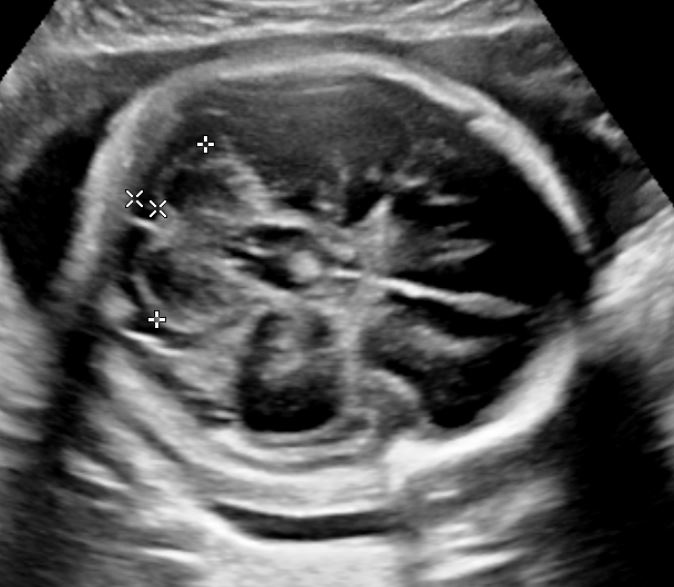 Evaluation of the cerebellum and cisterna magna in a second trimester fetus