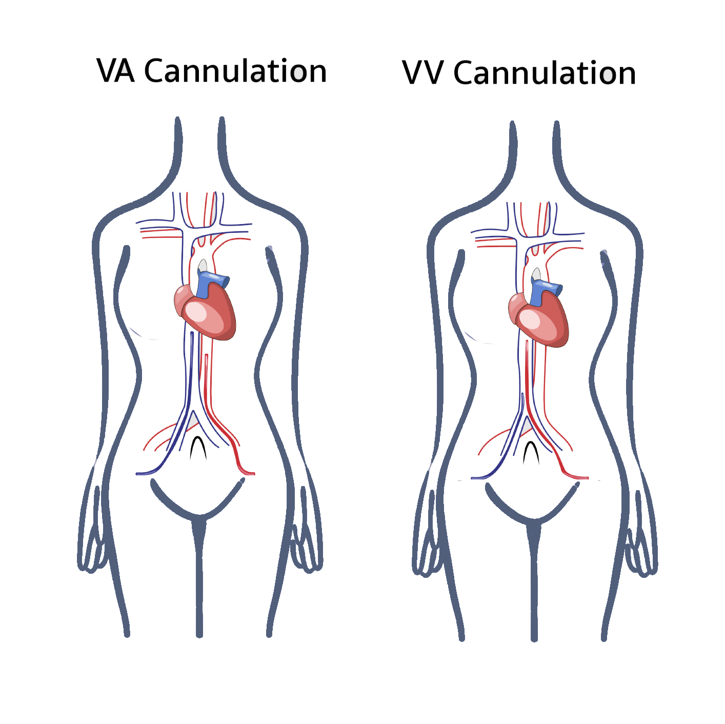Traditional VA and VV ECMO cannulation