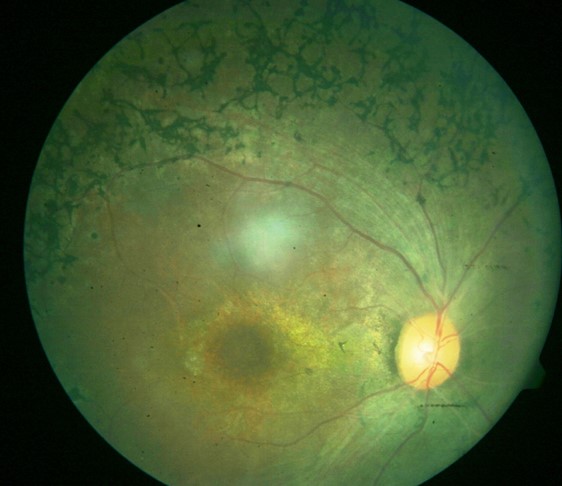 <p>Right Eye Retinitis Pigmentosa</p>