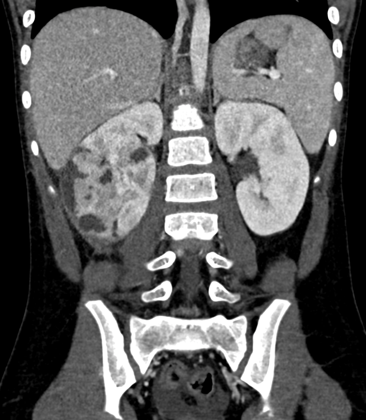 <p>Pyelonephritis With Renal Abscesses</p>