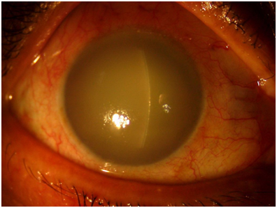 Elderly male patient presente with decreased vision , severe corneal edema and increase in intraocular pressure.