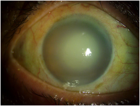 After treatment with  topical and systemic steoids and antiglaucoma medications, corneal edema decreased and a mature cataract was seen which was the reason for the lens induced inflammation.