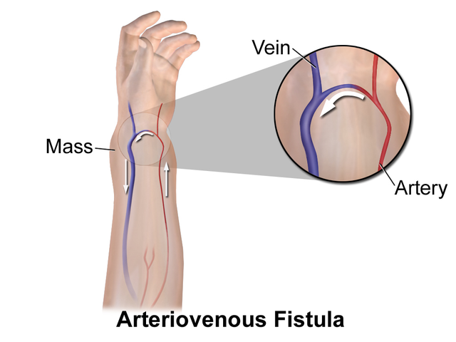 Diagram of arteriovenous fistula.