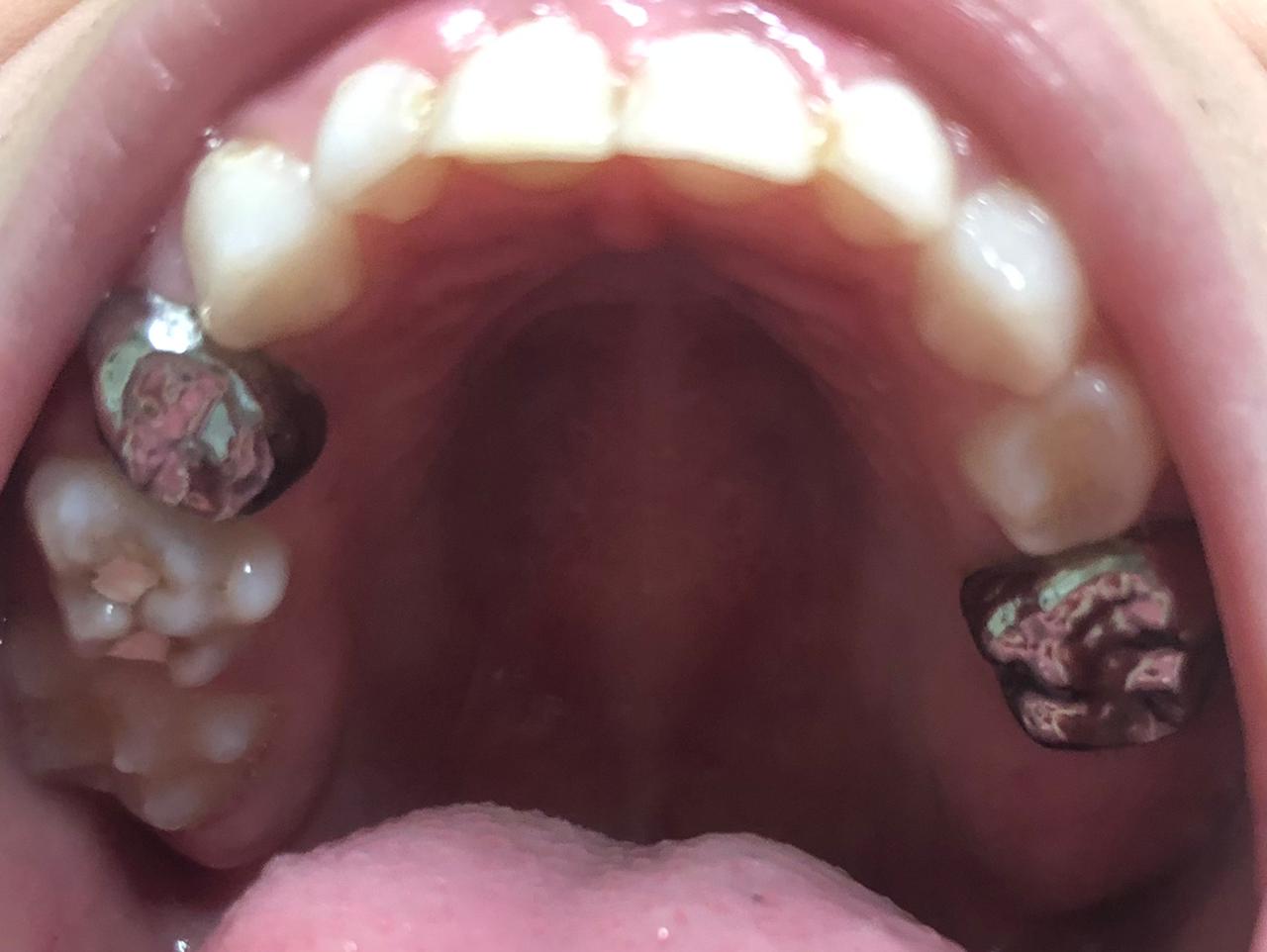 Stainless steel crowns in primary dentition