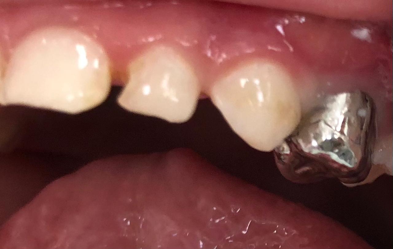 Stainless steel crown in primary first molar