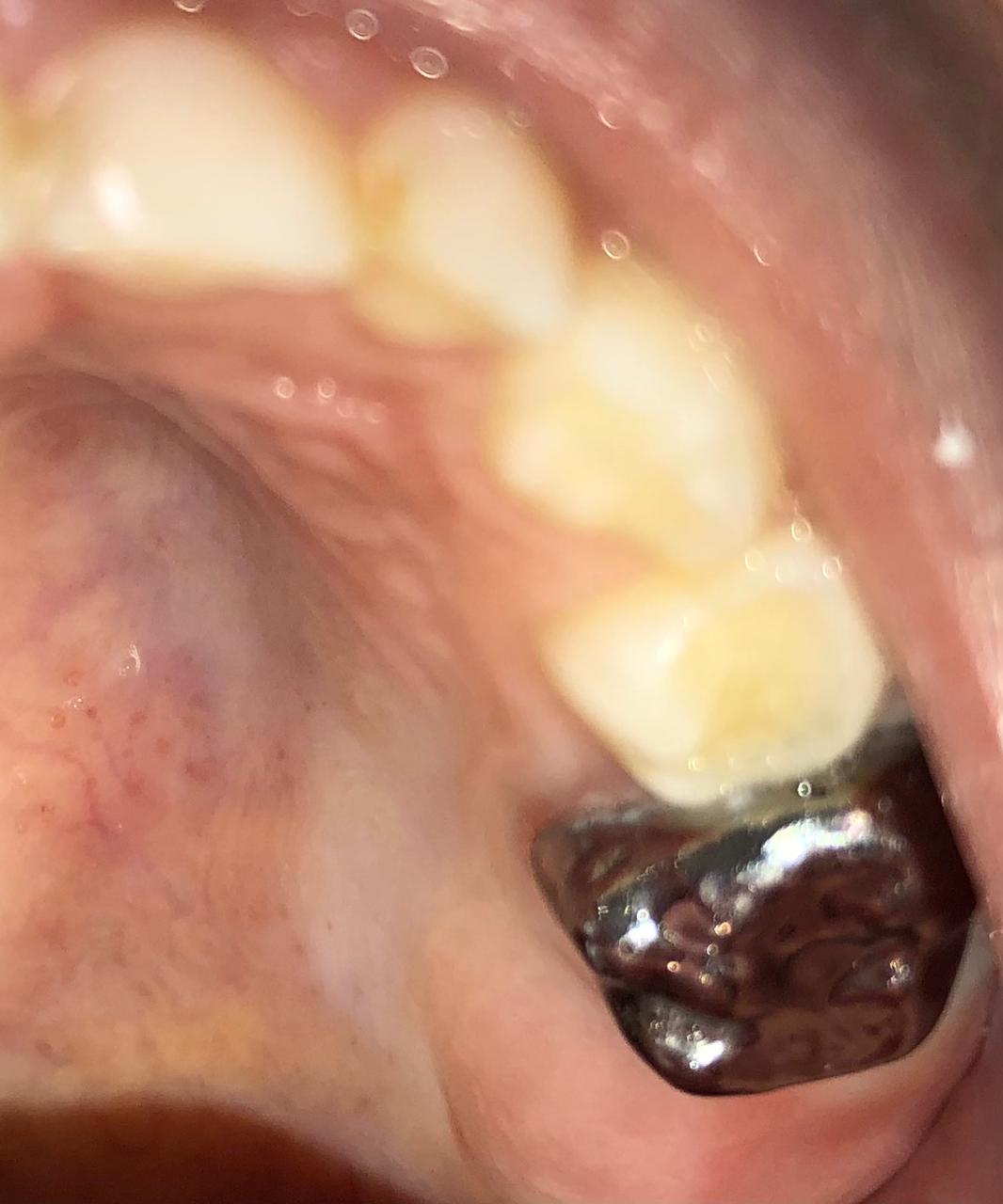 Stainless steel crown in primary second molar