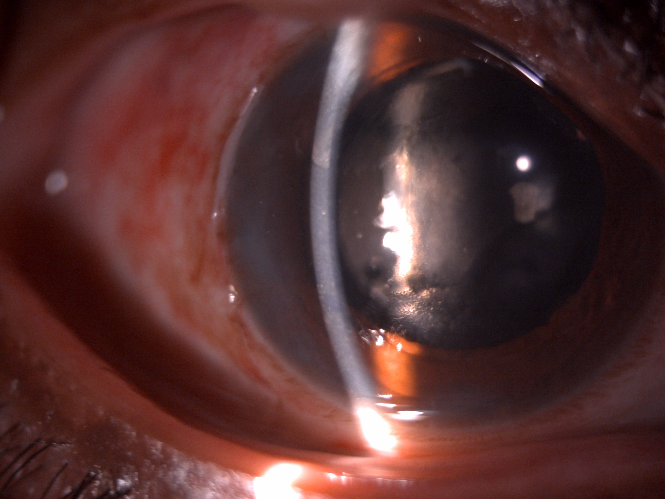 Postoperative day 1 slit lamp image of the patient after undergoing phacoemulsification with central 2+ striate keratopathy