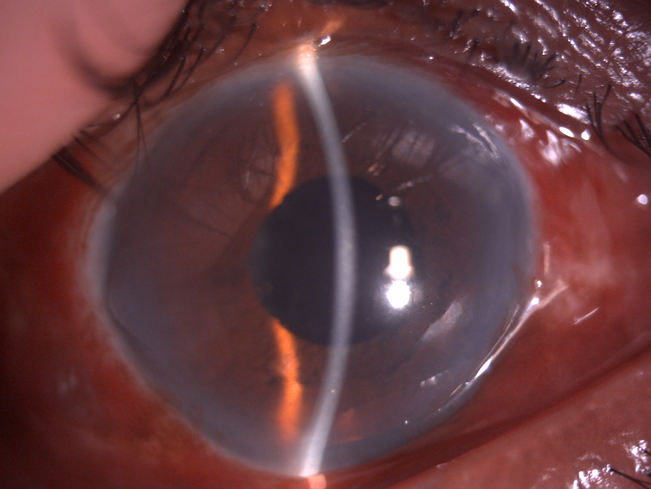 Postoperative slit lamp image of the patient after undergoing an uncomplicated phacoemulsification procedure