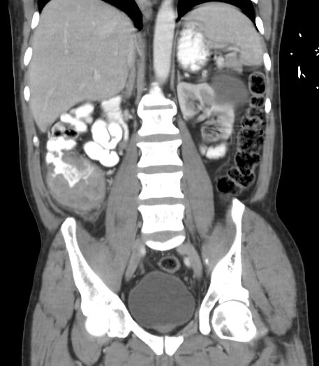 <p>Right-Sided Colon Cancer on Computed Tomography.&nbsp;</p>