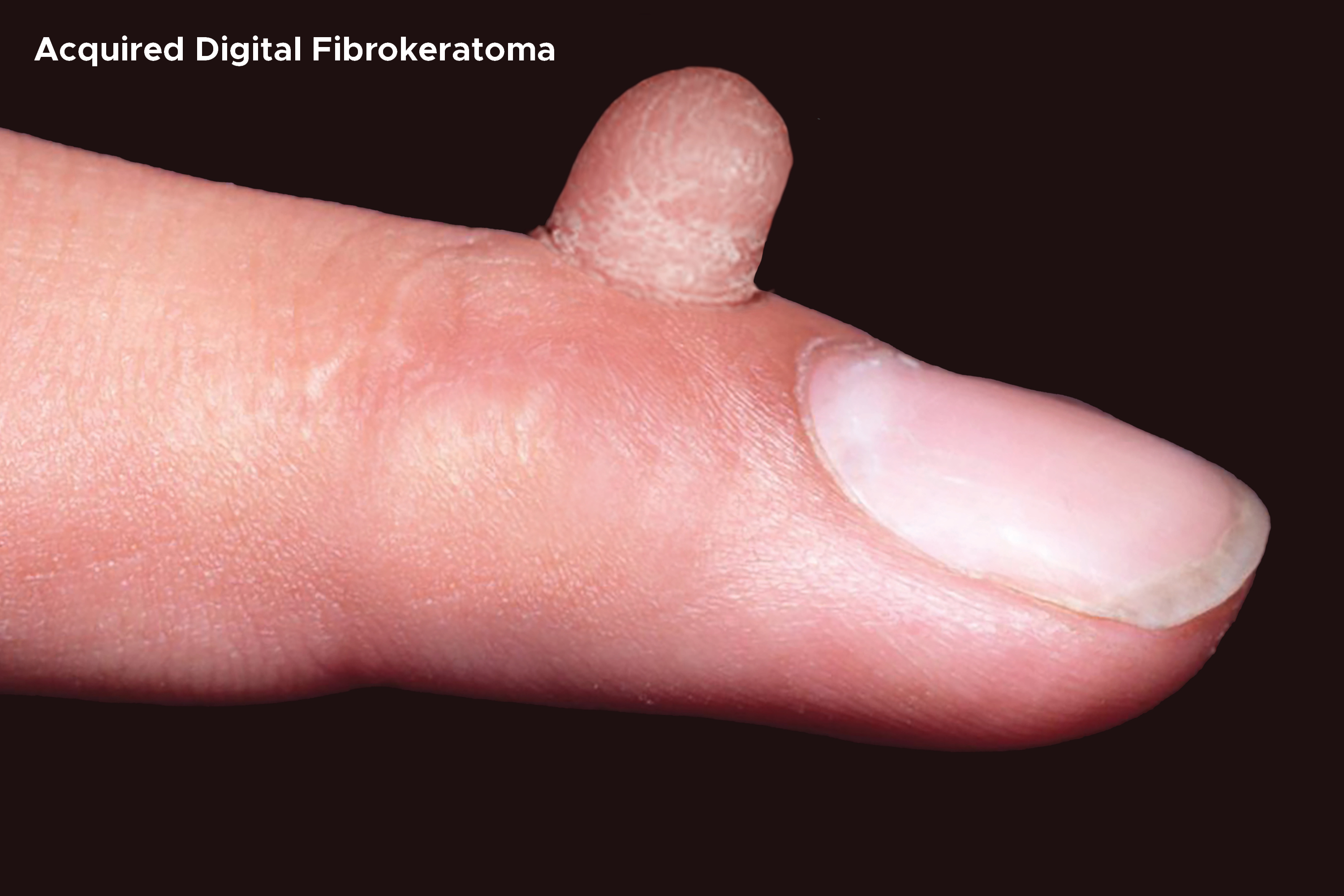 Acquired Digital Fibrokeratoma on index finger.