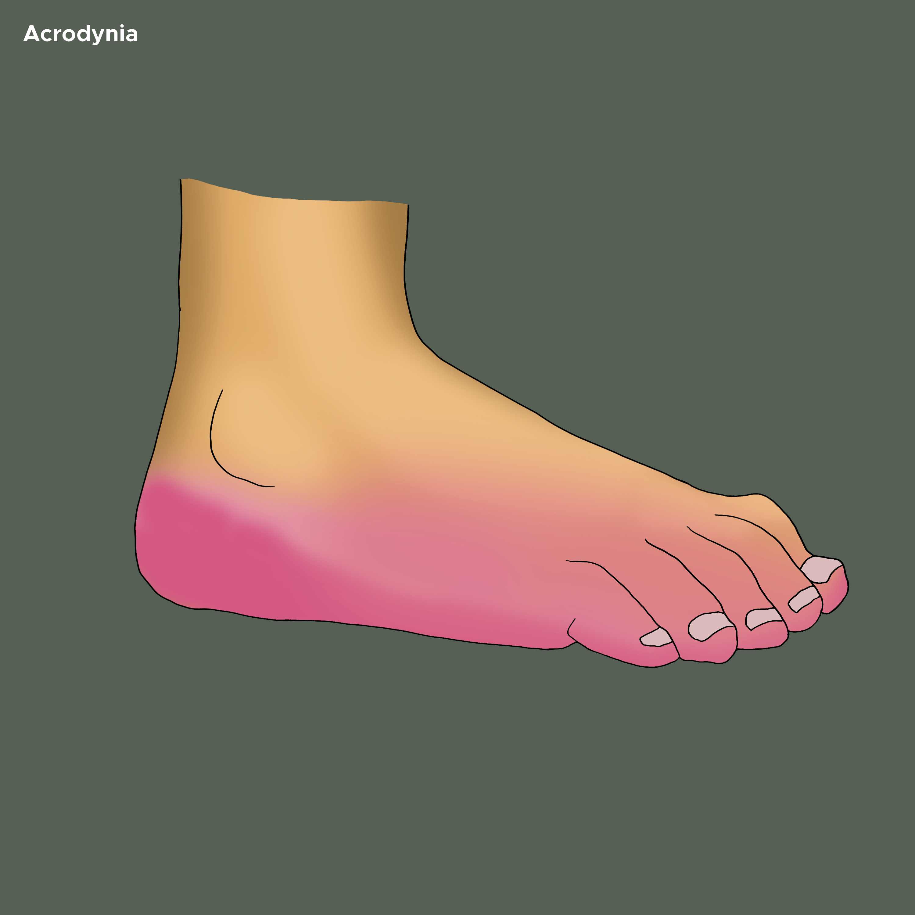 Illustration of Acrodynia on bottom of foot.
