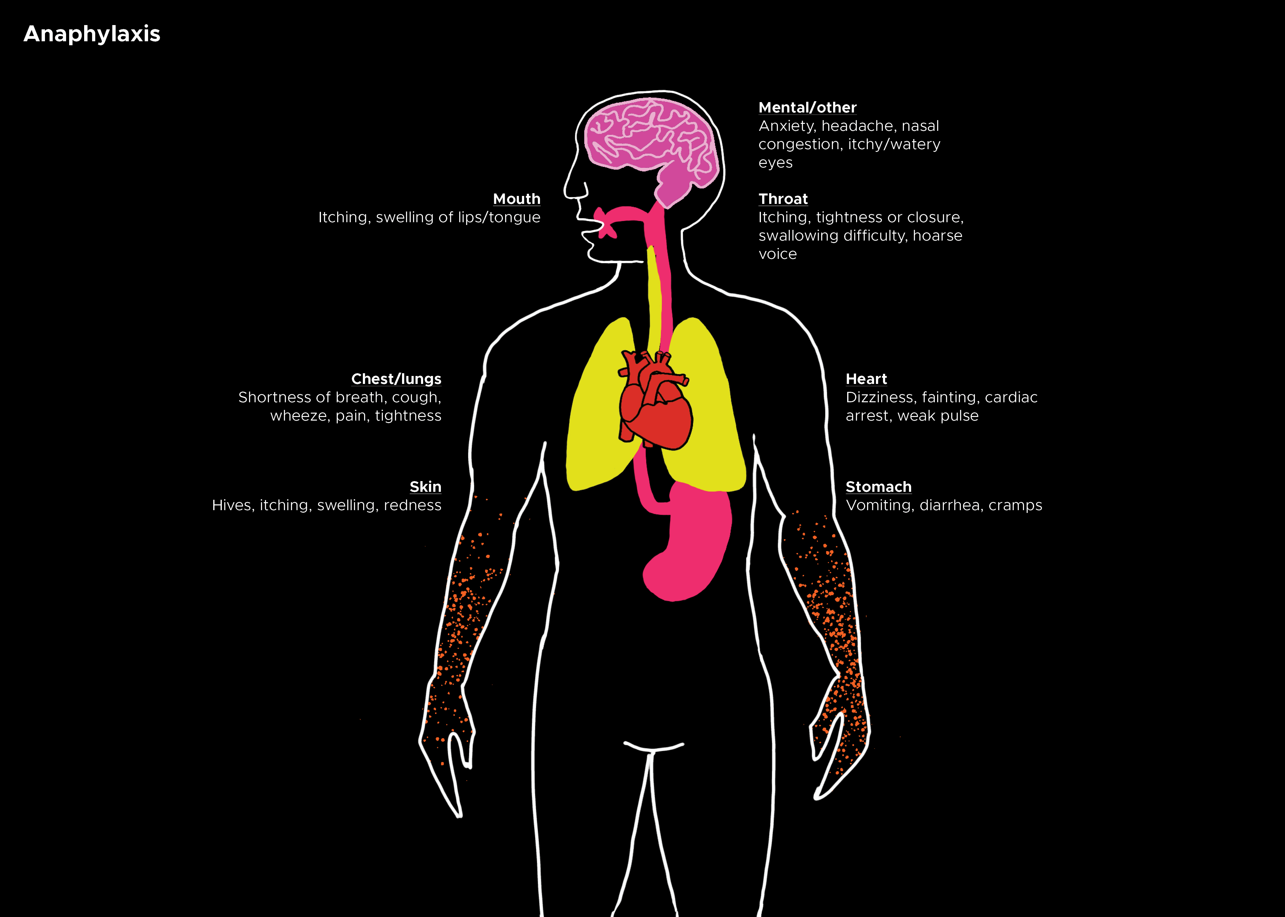 Chart depicting anaphylaxis in different areas of the body. Hives, difficulty breathing, increased heart rate, anxiety
