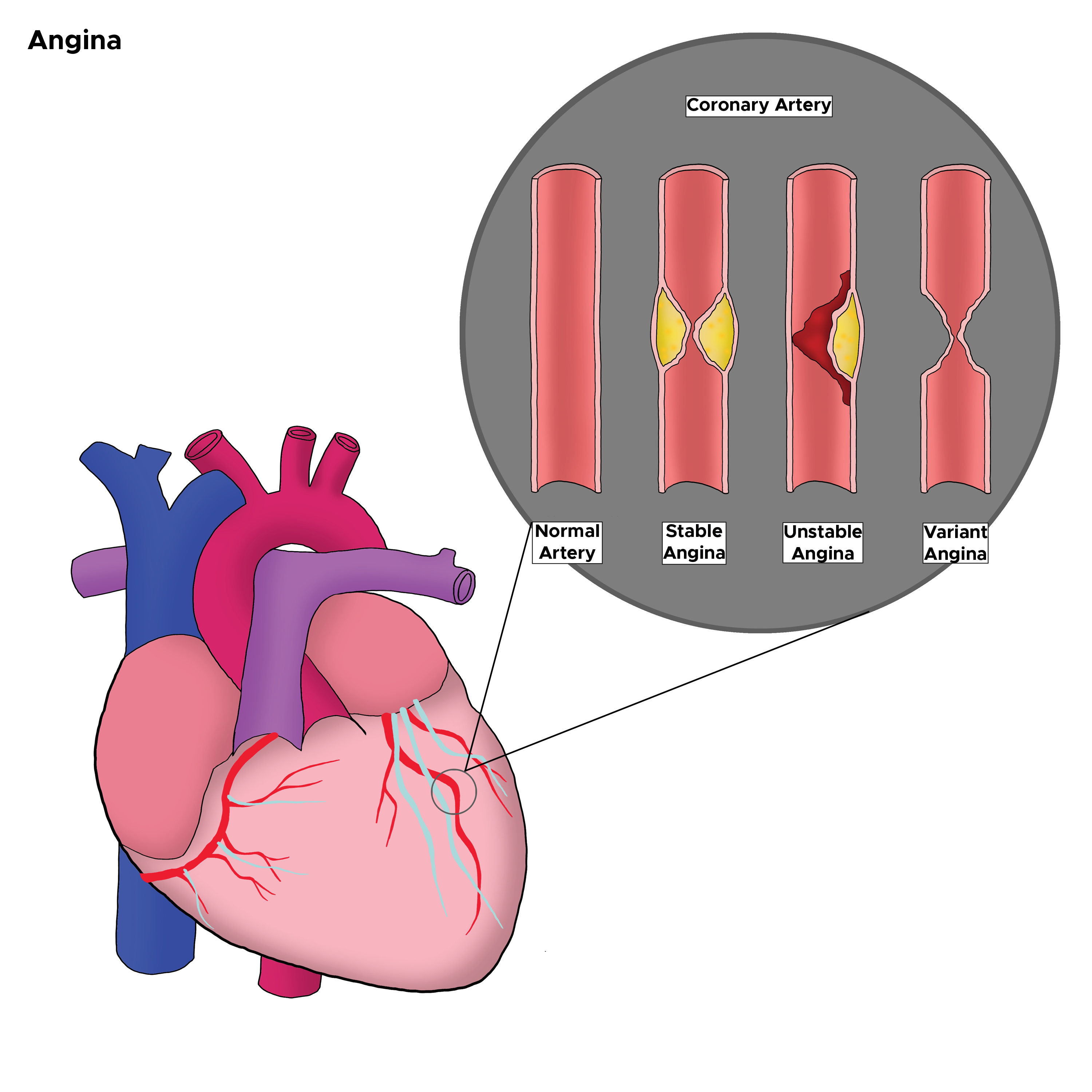 Different types of angina in the coronary artery. Stable angina, unstable angina, variant angina.