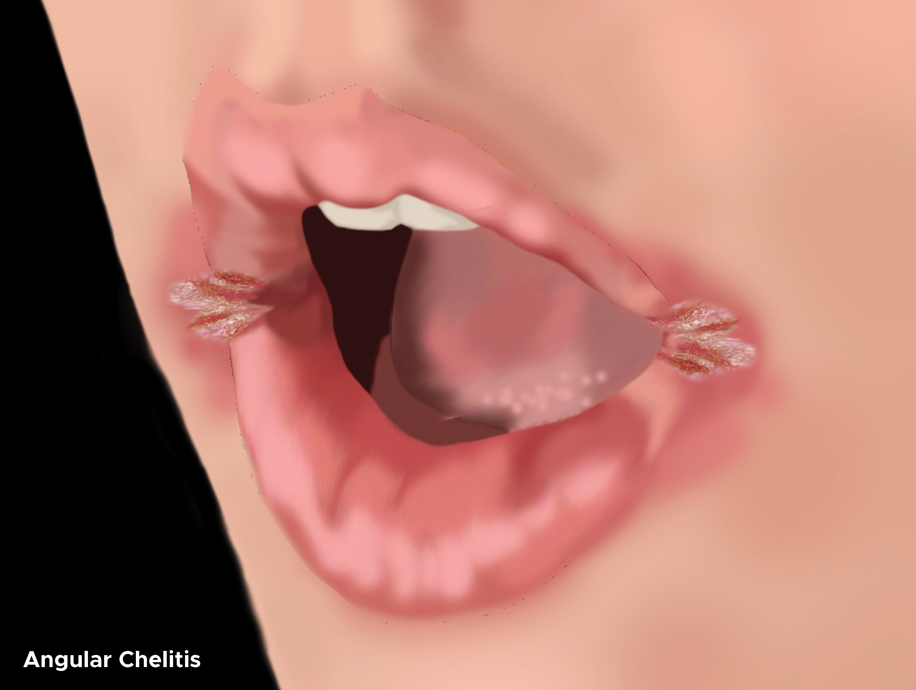 Illustration of cracks in corners of mouth due to angular chelitis. 