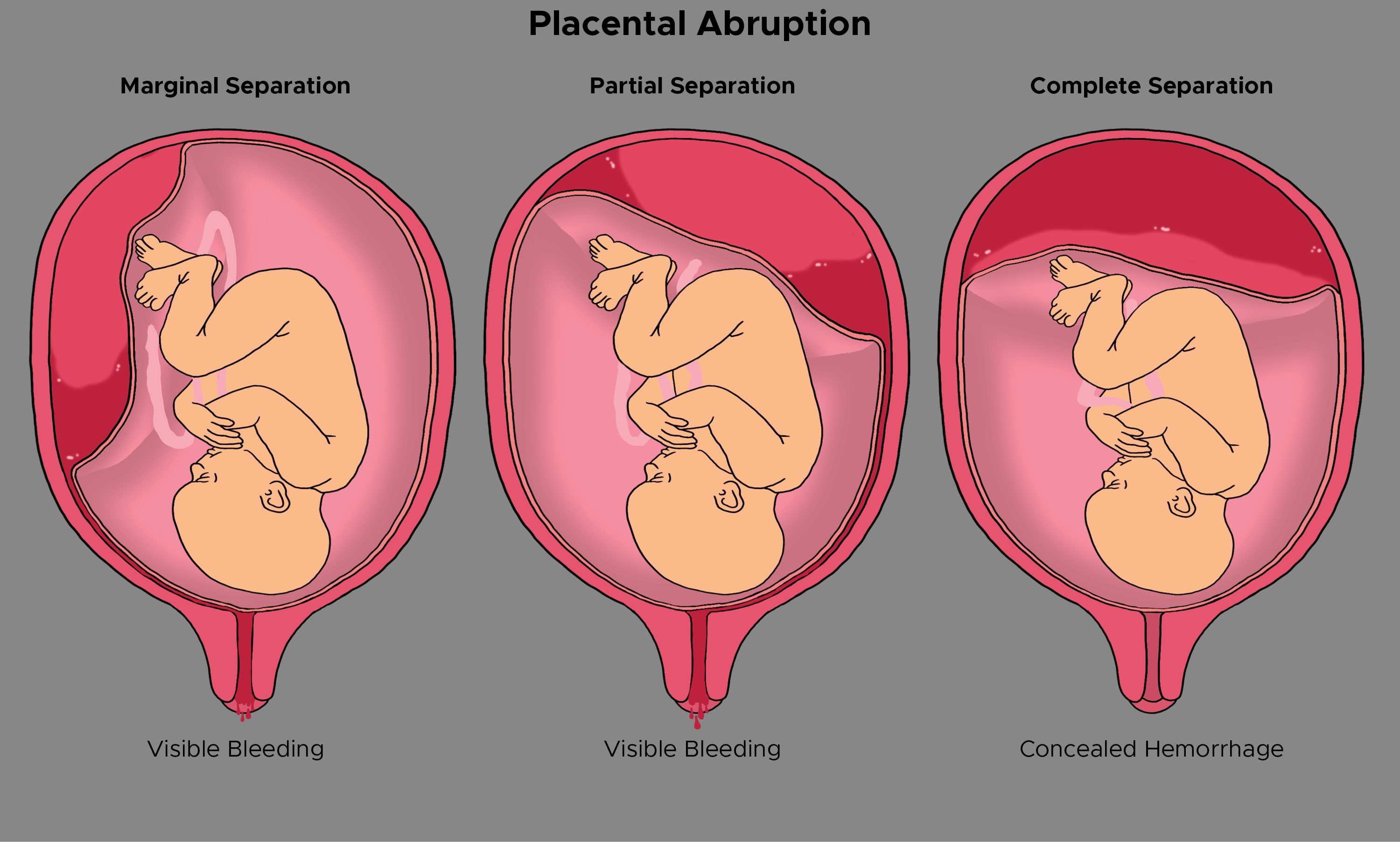 Illustration of placental abruption. Marginal separation, partial separation, complete separation with concealed hemorrhage. Cervical bleeding.