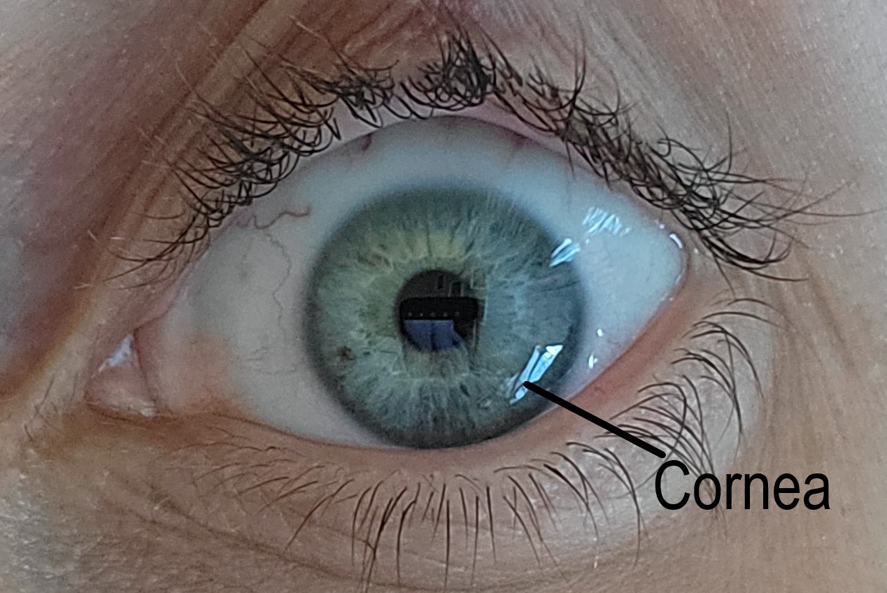 A normal cornea that is transparent, avascular, and acts as a barrier to infection. 