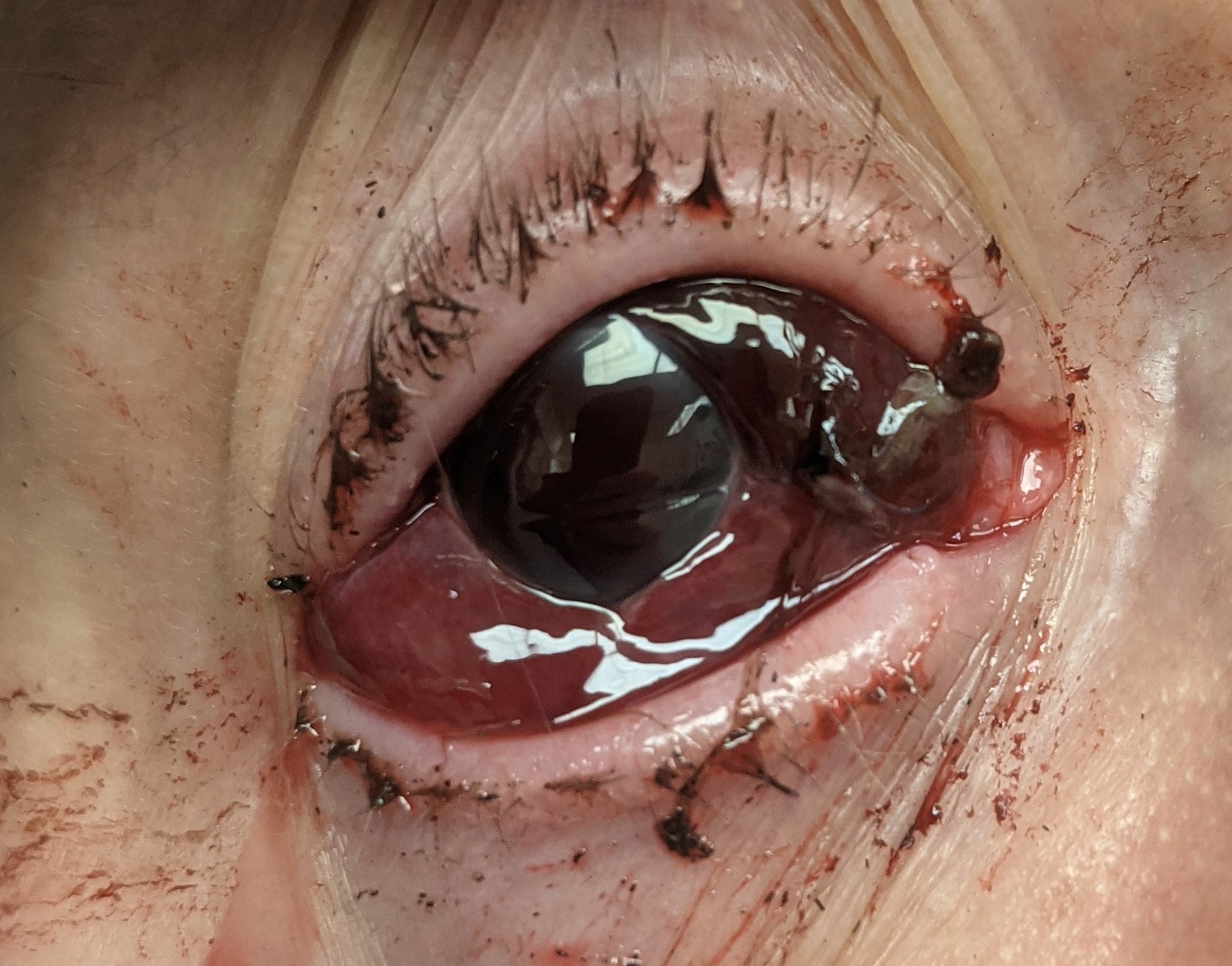 Corneoscleral laceration with tissue prolapse.