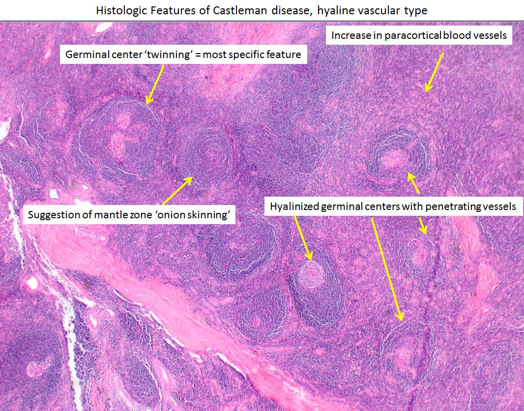 Hyaline vascular Castleman disease