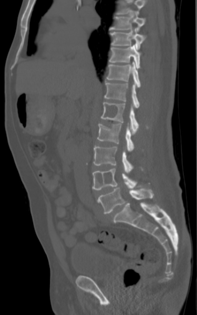 <p>Multiple Myeloma Involving the Spine