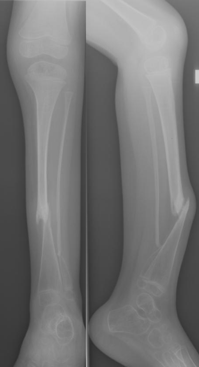 X-ray showing congenital tibial pseudarthrosis.
