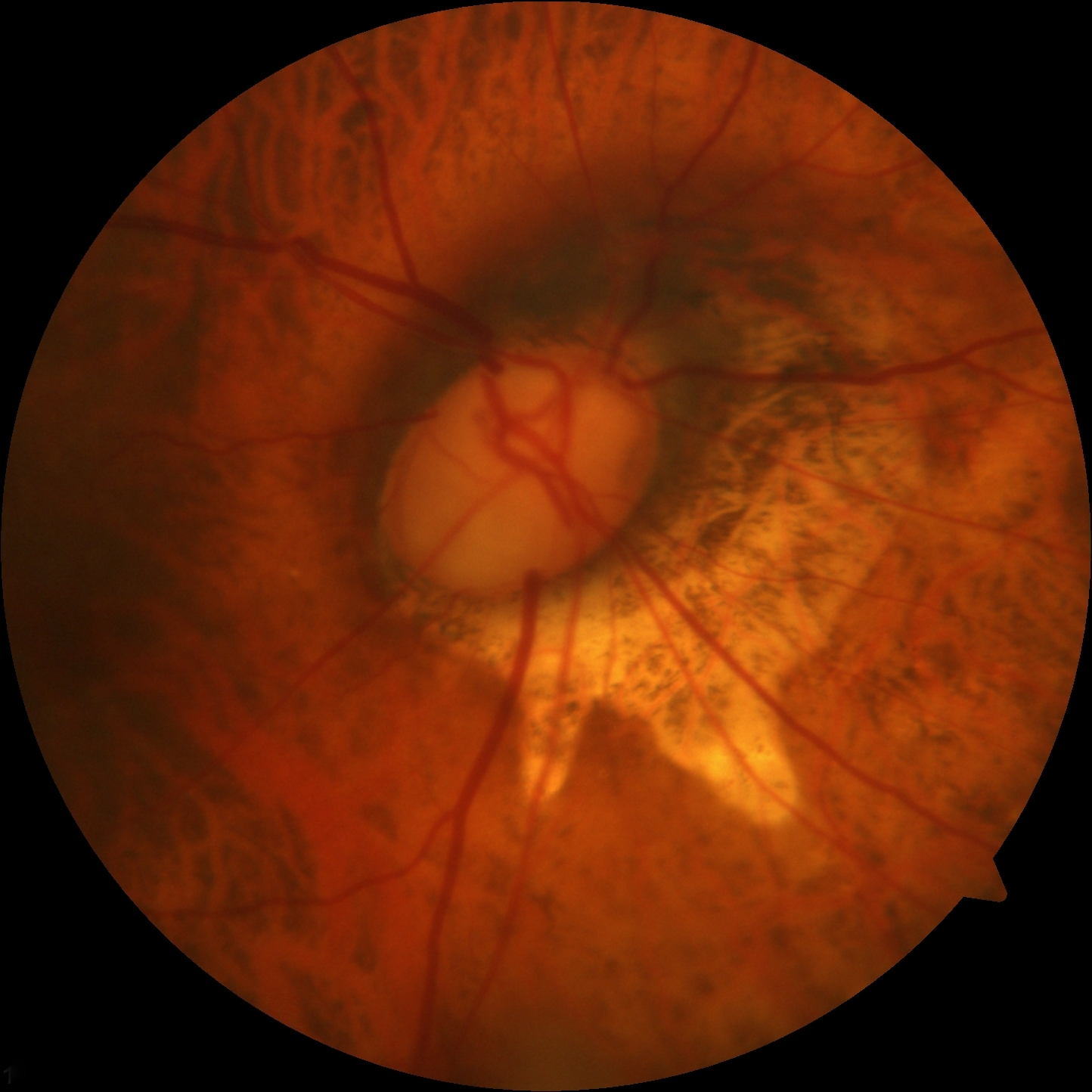 <p>Advanced Glaucomatous Damage to the Optic Nerve